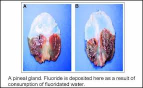 pineal gland calcification yang tercinta bumi glands calcified