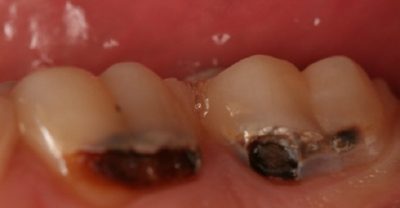 Healing Cavities (A True 'We've-Done-It!' Story!)