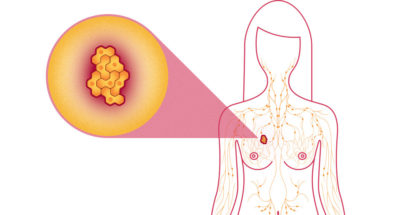 turmeric-breast-cancer